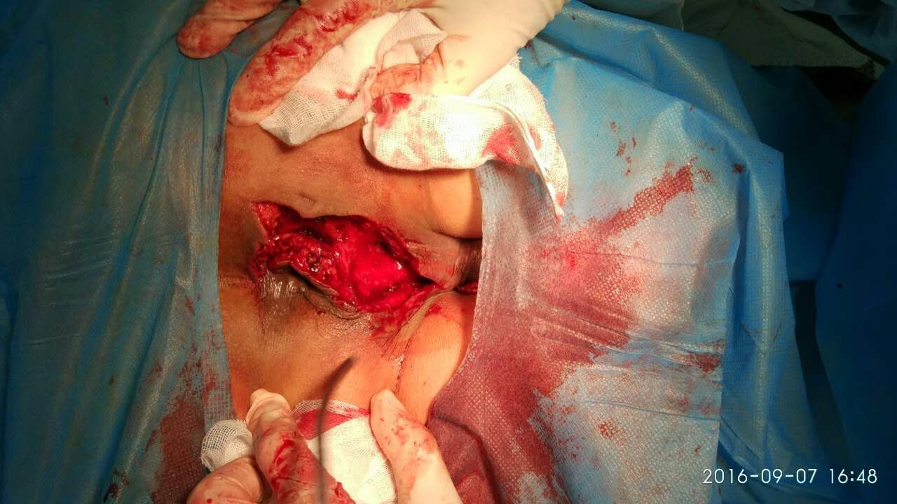 外痔疮最佳治疗方法_胃胀气自愈的最佳方法_外痔疮最佳的自愈方法提肛