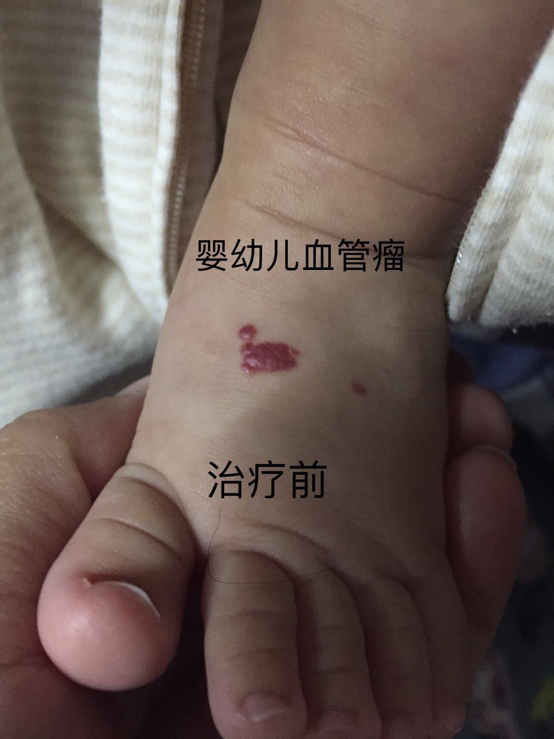 嬰幼兒血管瘤及化膿性肉芽腫治療策略