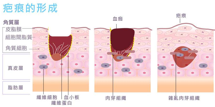  !--haodf:8:bahen-->疤痕 !--haodf:/8:bahen-->的形成2.png