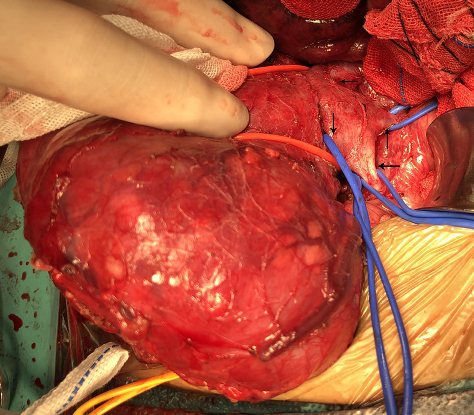 肾母细胞瘤 mip.haodf.com