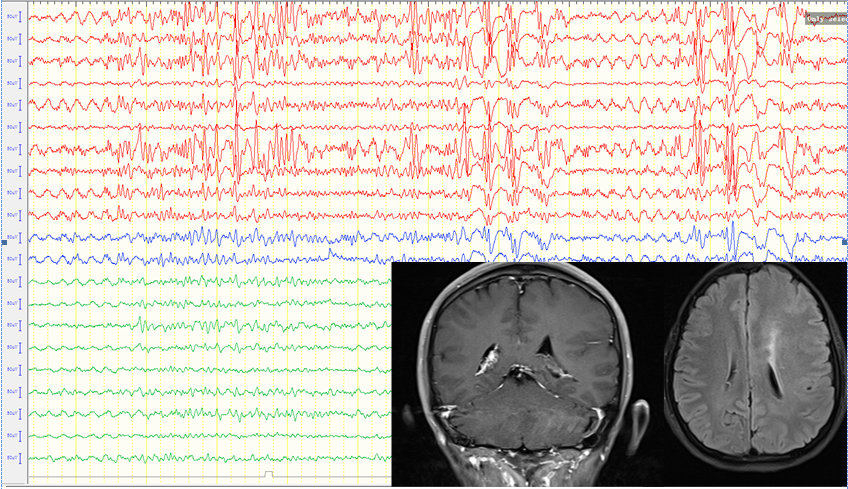 上图示:癫痫外科术前初步脑电图定位:eeg:左侧半球持续棘波节律(头颅