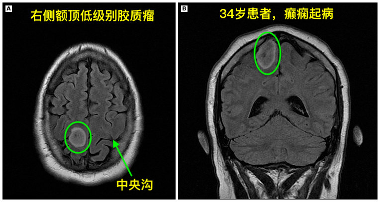 腦瘤是如何診斷的